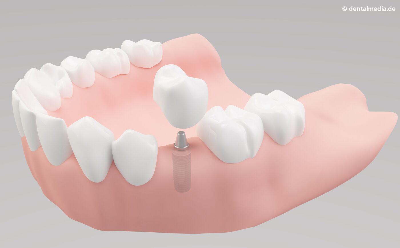 Implantologie : Ein Zahn fehlt  Ein Implantat hat gegenüber einer Brücke den Vorteil, dass Nachbarzähne nicht beschliffen werden müssen.